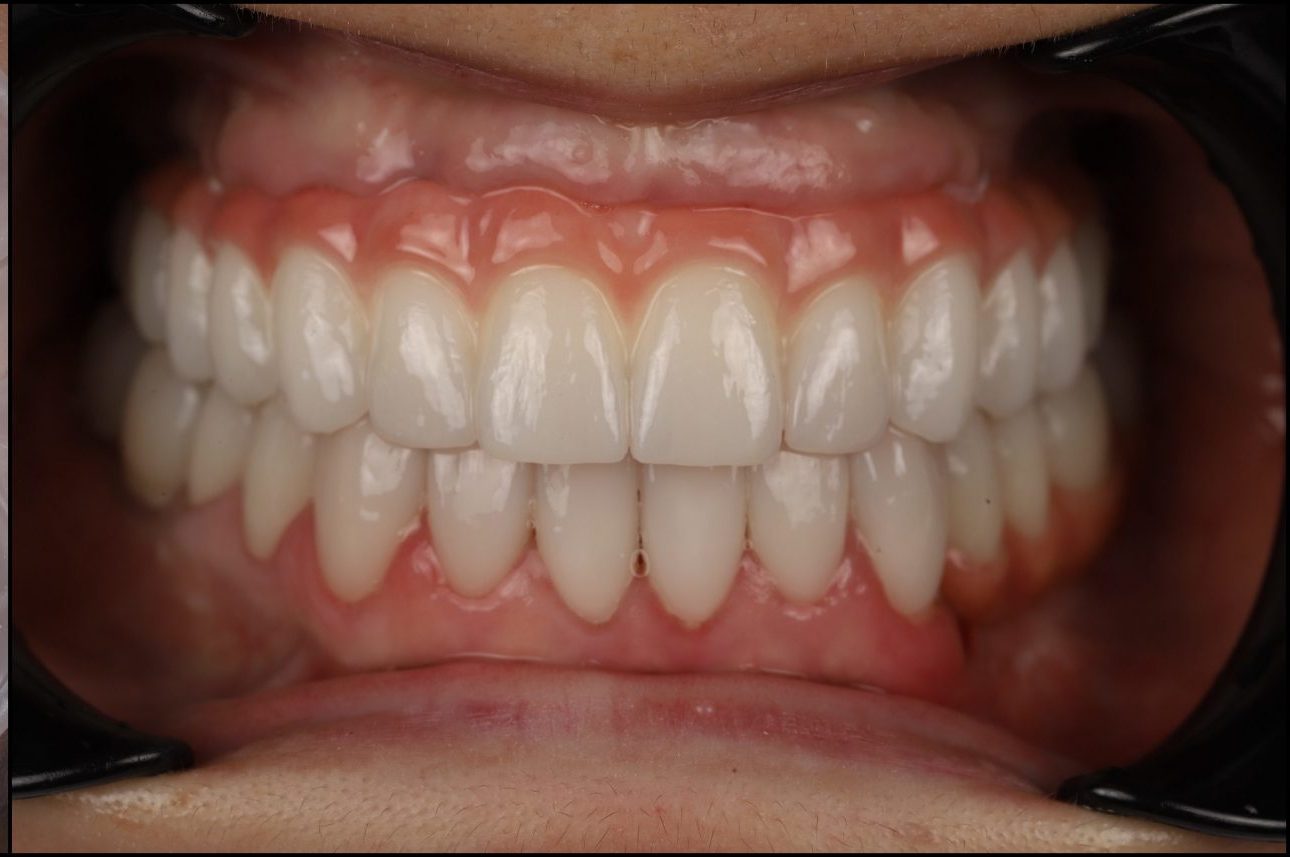 After treatment
